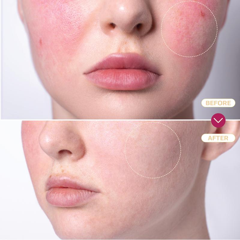 Base Laboratories Hypochlorous Acid Spray & Wipes Bundle - 75 Wipes & 8oz Spray for Acne Eczema Piercings & Irritations Fast Relief for Daily Use