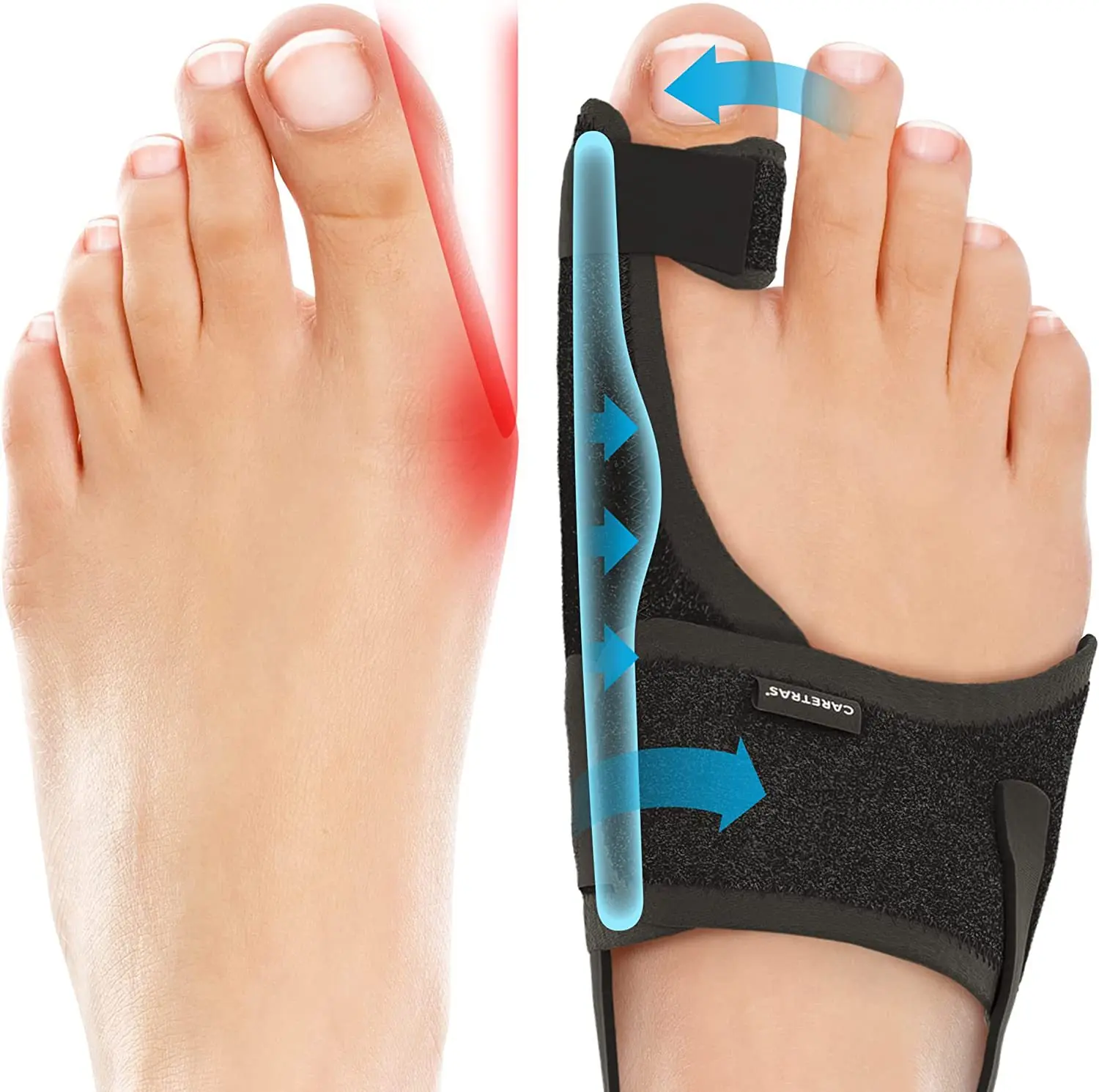 Hallux Valgus Corrector Brace - Big Toe Straightener & Pain Relief for ...